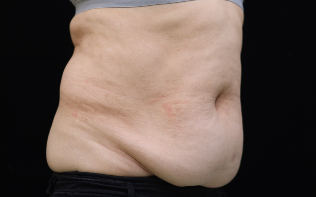 烟台曙光整形医院吸脂怎么样？53岁的姐姐也来吸脂了！